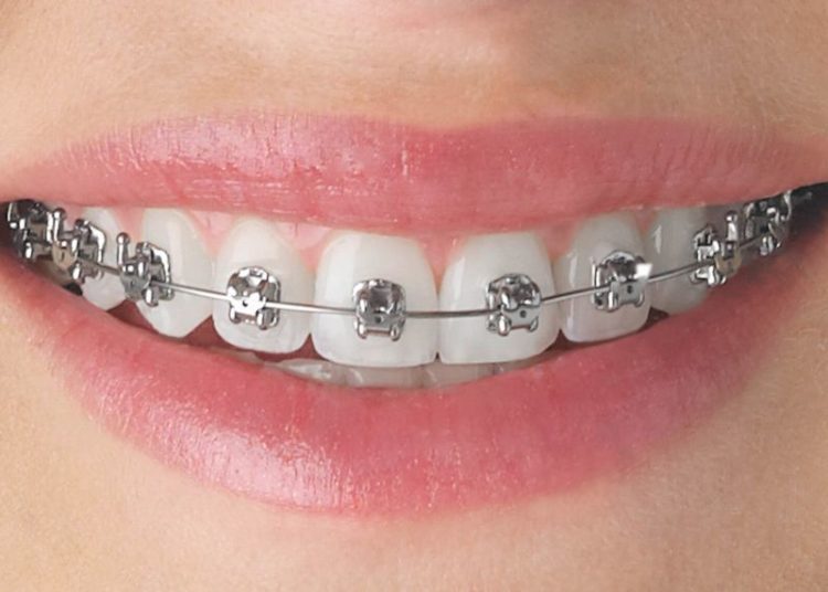 Giai đoạn chỉnh khớp cắn và duy trì 1