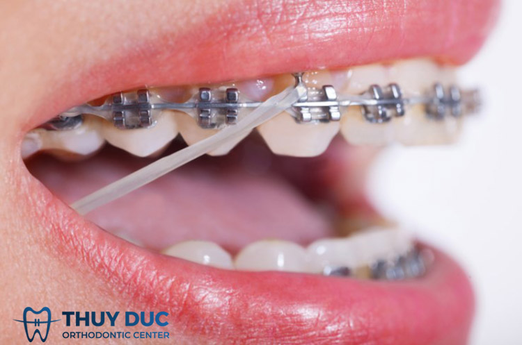 Thun liên hàm (Rubber bands) 1 Thun liên hàm (Rubber bands) 1