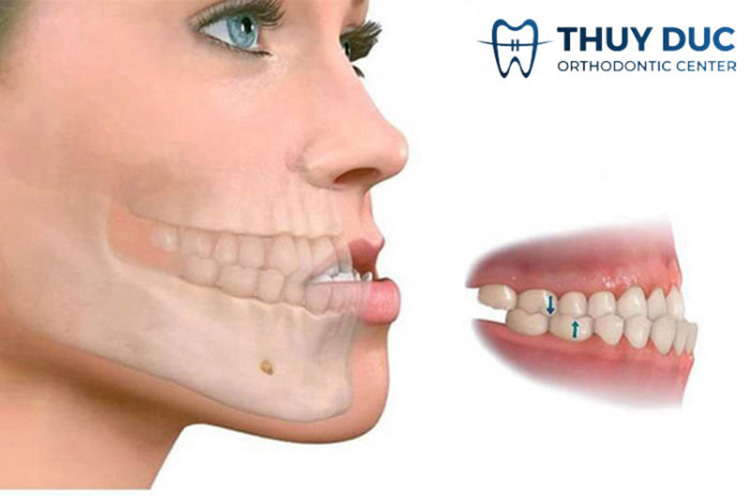 Những hậu quả do răng móm gây ra 1 Những hậu quả do răng móm gây ra 1