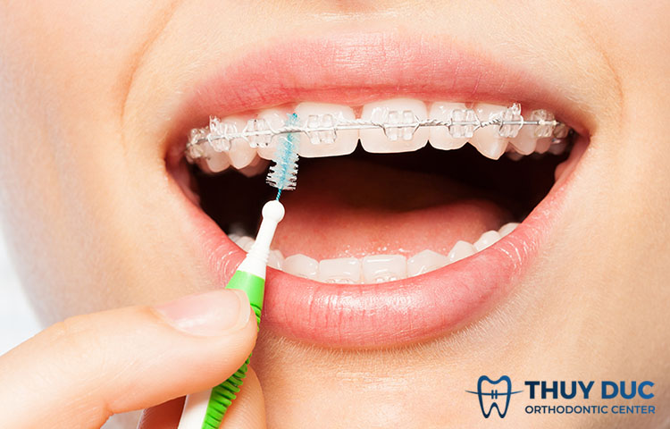 Những lưu ý khi sử dụng dây thun niềng răng 1 Những lưu ý khi sử dụng dây thun niềng răng 1