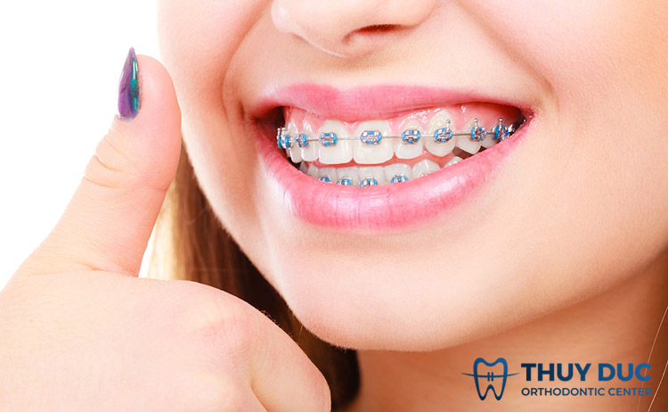 Niềng răng mắc cài kim loại 1 Niềng răng mắc cài kim loại 1