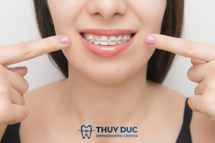 Niềng răng ở người lớn mất thời gian bao lâu? 1 Niềng răng ở người lớn mất thời gian bao lâu? 1