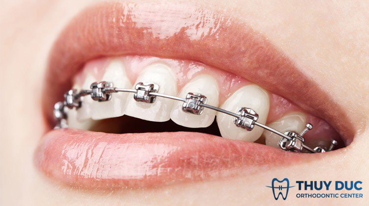 Niềng răng mắc cài kim loại tự động 1
