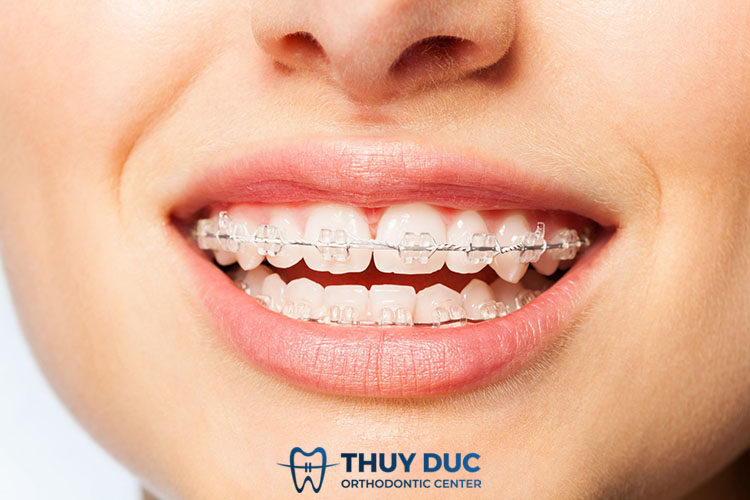 Niềng răng mắc cài sứ 1 Niềng răng mắc cài sứ 1