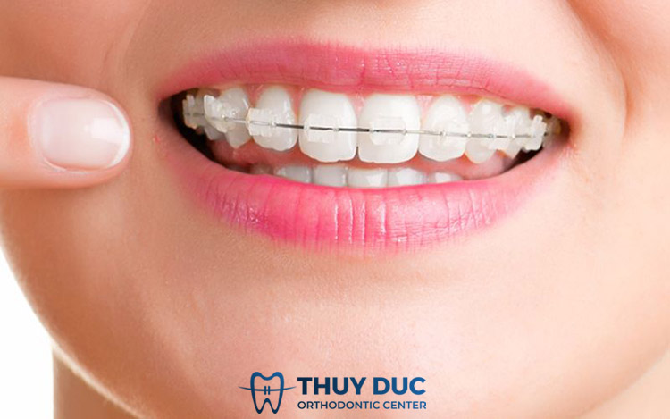 Niềng răng mắc cài sứ tự động 1