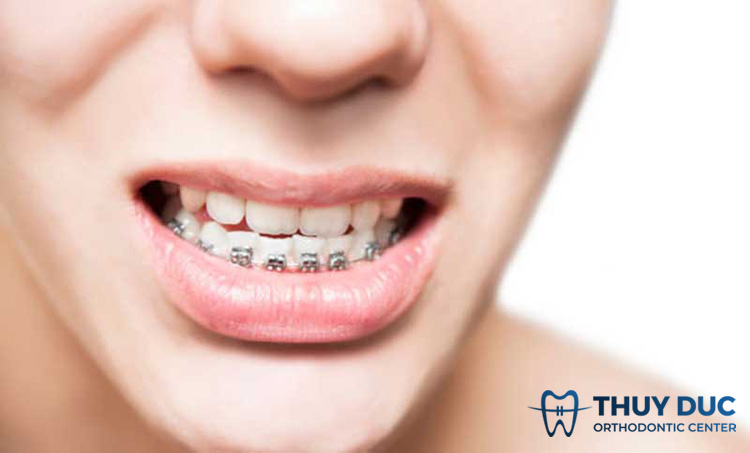 Niềng răng mắc cài kim loại 1 Niềng răng mắc cài kim loại 1