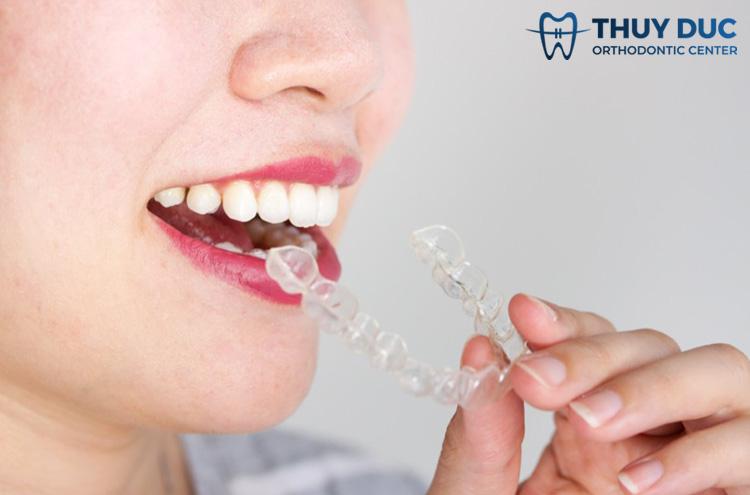 Lựa chọn công nghệ niềng răng 2 Lựa chọn công nghệ niềng răng 2