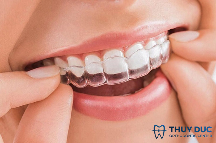 Niềng răng trong suốt Invisalign 1 Niềng răng trong suốt Invisalign 1