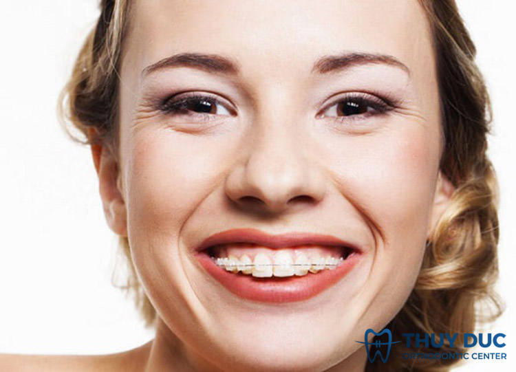 Vì sao niềng răng xong bị lệch nhân trung? 1