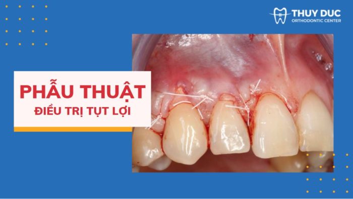 Đối với trường hợp tụt lợi nặng 1 Đối với trường hợp tụt lợi nặng 1