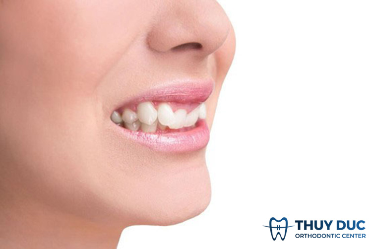 Răng bị quặp là gì? Nguyên nhân do đâu? 1 Răng bị quặp là gì? Nguyên nhân do đâu? 1