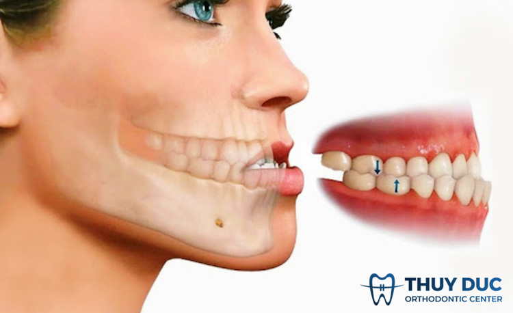 Răng móm là gì? Có biểu hiện như thế nào? 1