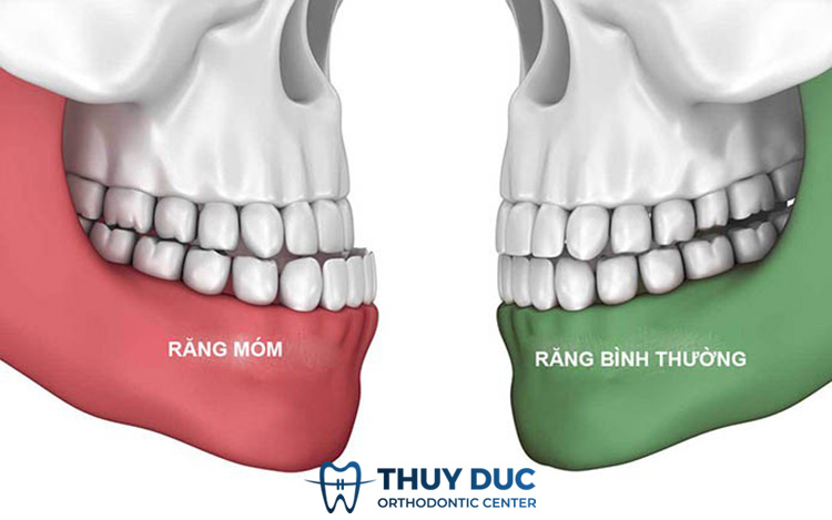 Răng móm là gì? Có những trường hợp nào? 1 Răng móm là gì? Có những trường hợp nào? 1