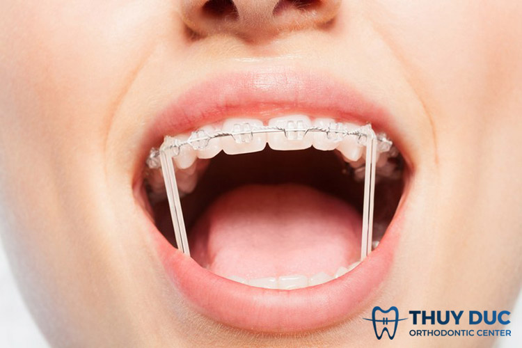 Dây thun niềng răng có tác dụng như thế nào trong điều chỉnh vị trí hai hàm?
