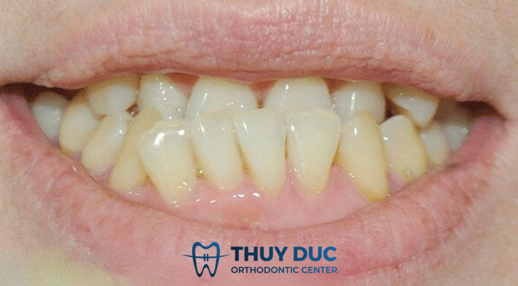 Những tác hại khôn lường của răng bị quặp 1 Những tác hại khôn lường của răng bị quặp 1