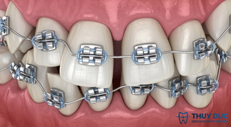 Thời gian để niềng răng bị quặp là bao lâu? 1 Thời gian để niềng răng bị quặp là bao lâu? 1