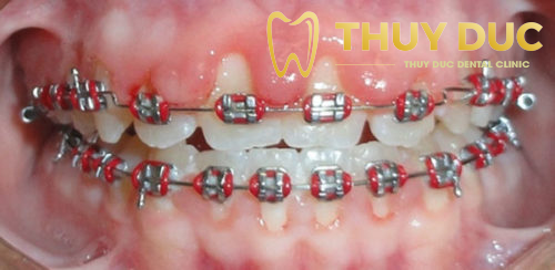 Tụt lợi khi niềng răng có ảnh hưởng gì không? 1 Tụt lợi khi niềng răng có ảnh hưởng gì không? 1