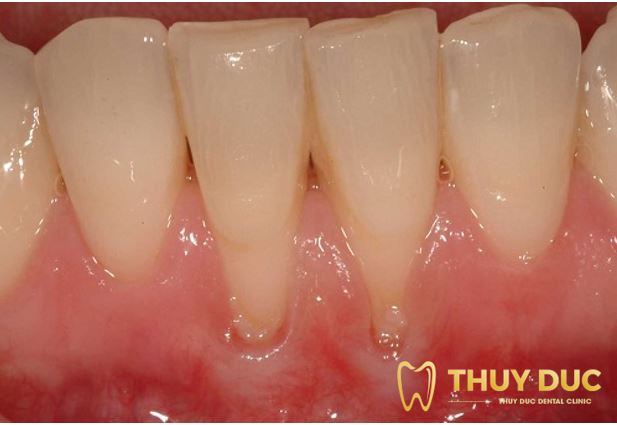 Tụt lợi là gì? Dấu hiệu nhận biết tụt lợi khi niềng răng? 1 Tụt lợi là gì? Dấu hiệu nhận biết tụt lợi khi niềng răng? 1