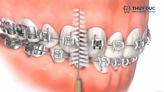Vệ sinh răng niềng bằng bàn chải kẽ 1 Vệ sinh răng niềng bằng bàn chải kẽ 1