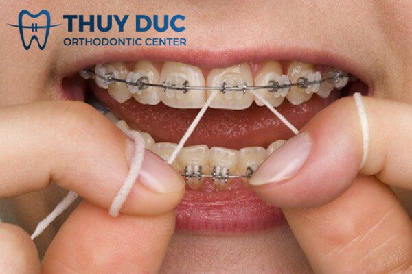 Chỉ nha khoa 1 Chỉ nha khoa 1
