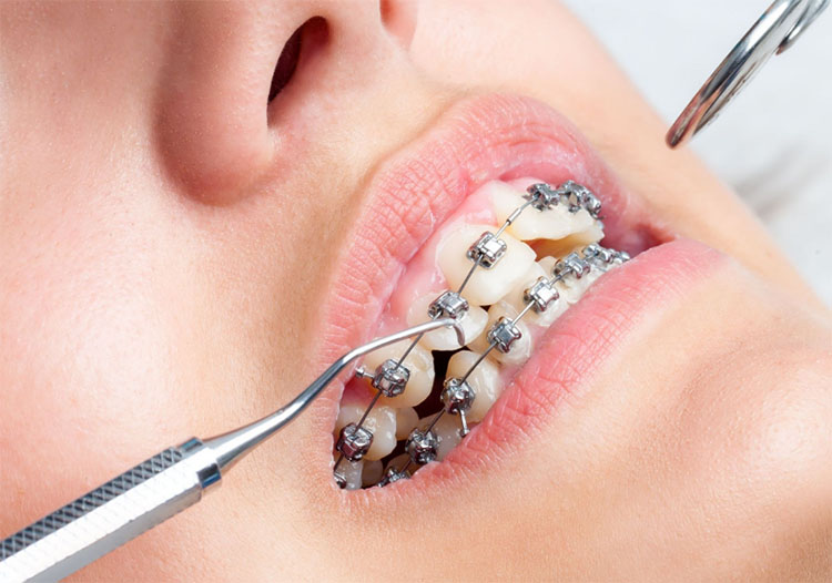 Niềng răng ở người lớn mất thời gian bao lâu? 2 Niềng răng ở người lớn mất thời gian bao lâu? 2