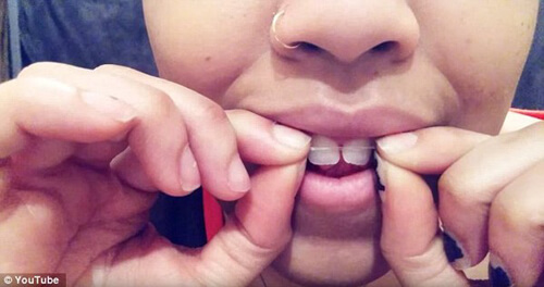 Thực hư hiệu quả của việc niềng răng tại nhà 1 Thực hư hiệu quả của việc niềng răng tại nhà 1