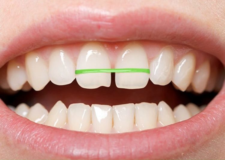 Dụng cụ niềng răng tự chế 1 Dụng cụ niềng răng tự chế 1