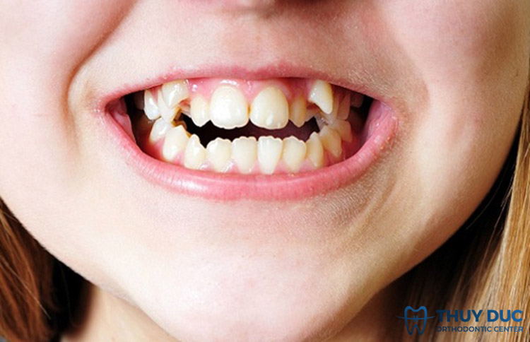 Làm thế nào để xử lý răng lòi xỉ xấu?

