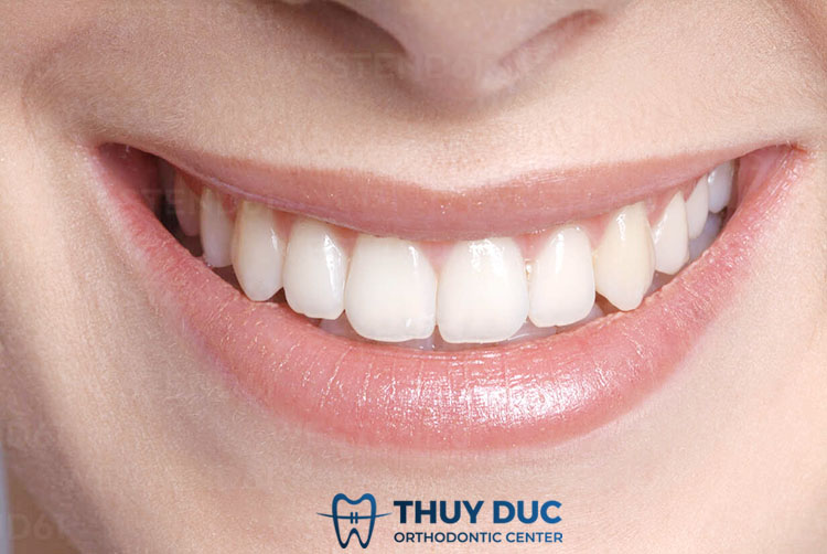 Bọc răng sứ 1 Bọc răng sứ 1