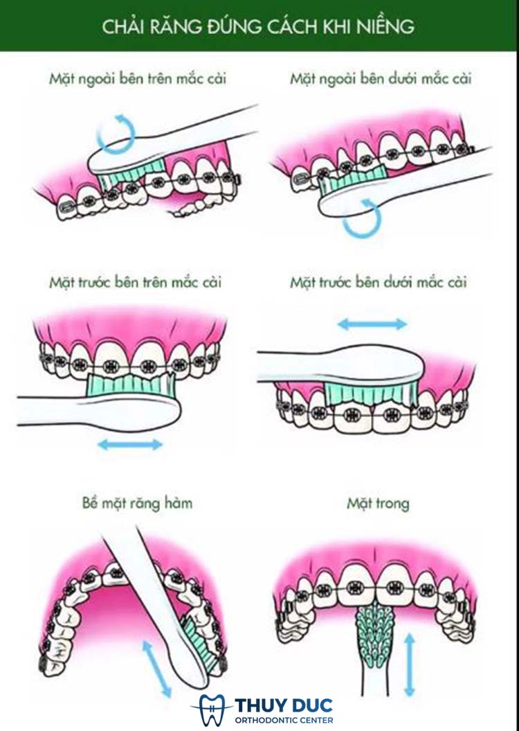 Hướng dẫn chải răng đúng cách cho người niềng răng 1 Hướng dẫn chải răng đúng cách cho người niềng răng 1