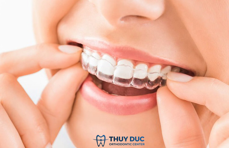 Động tác đeo khay niềng Invisalign 1 Động tác đeo khay niềng Invisalign 1