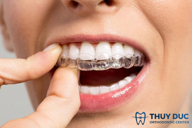 Động tác tháo khay niềng Invisalign 1 Động tác tháo khay niềng Invisalign 1