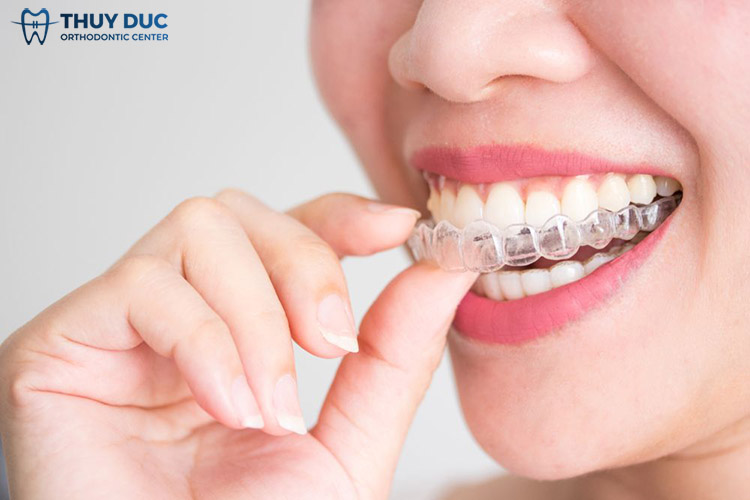 Lưu ý thời gian và tần suất tháo lắp khay Invisalign 1 Lưu ý thời gian và tần suất tháo lắp khay Invisalign 1