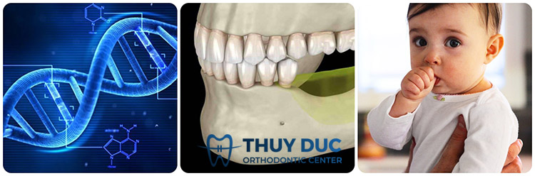 Những nguyên nhân dẫn tới răng bị lòi xỉ 1 Những nguyên nhân dẫn tới răng bị lòi xỉ 1