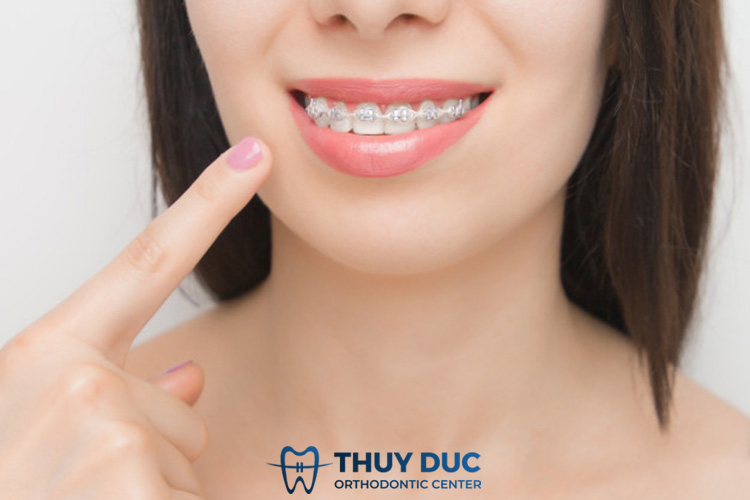 Niềng răng 1 Niềng răng 1