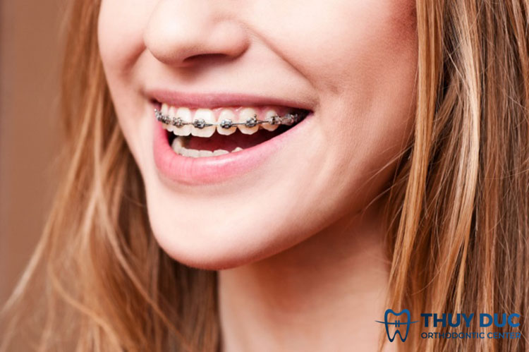 Niềng răng 1 Niềng răng 1