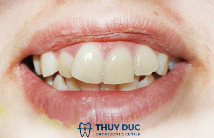 Răng cửa mọc lệch là gì? Có những dạng nào? 1 Răng cửa mọc lệch là gì? Có những dạng nào? 1