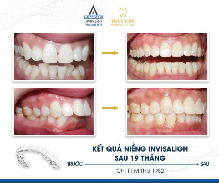 Hiểu lầm 1: Niềng răng Invisalign chỉ giải quyết được những ca nhẹ 1