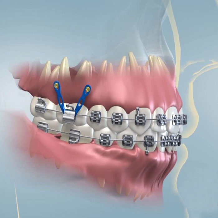 Đánh lún bằng minivis 1