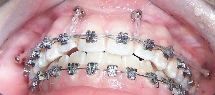 Đánh lún răng là gì và khi nào cần đánh lún răng? 1