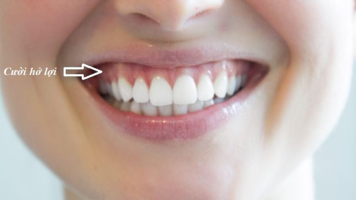 Khi nào cần thực hiện đánh lún răng 1