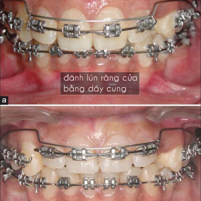 Đánh lún bằng dây cung 1