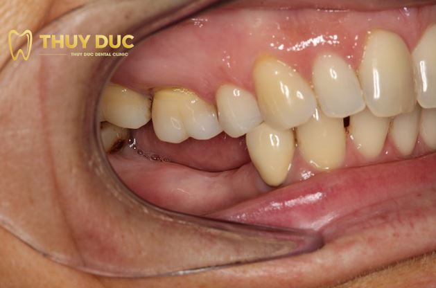 Trường hợp 1: Mất răng số 7 - Kéo răng số 8 để thay thế 1