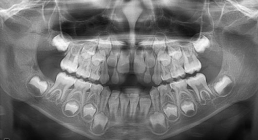 Chụp X-quang khi niềng răng để làm gì? Khi nào cần thực hiện? - Bác sĩ Đức  AAO