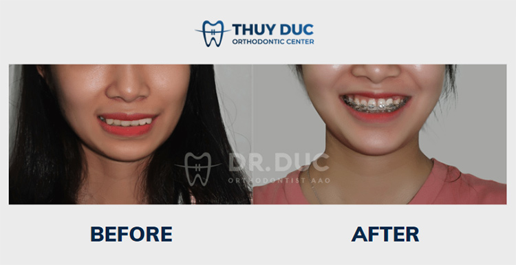 Hình ảnh trước- sau với niềng răng mắc cài kim loại 2 Hình ảnh trước- sau với niềng răng mắc cài kim loại 2