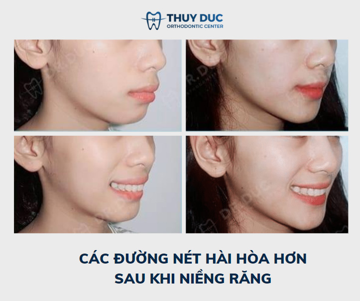 Hình ảnh thay đổi trước và sau khi niềng răng hô tại Nha khoa Thúy Đức 4