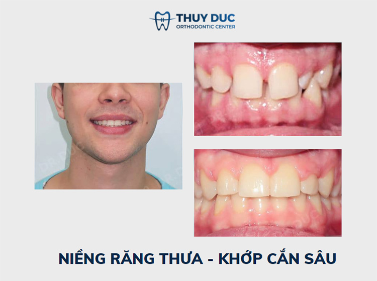 Hình ảnh trước – sau niềng răng với răng sai khớp cắn 7 Hình ảnh trước – sau niềng răng với răng sai khớp cắn 7