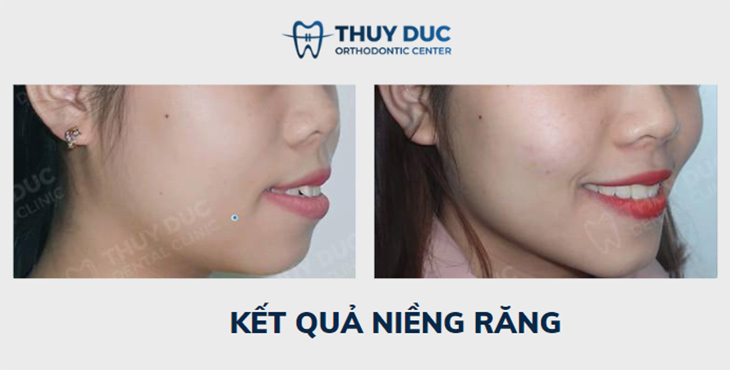 Hình ảnh thay đổi trước và sau khi niềng răng hô tại Nha khoa Thúy Đức 8