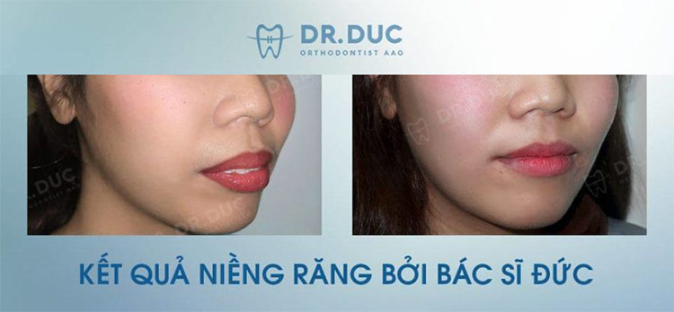Hình ảnh thay đổi trước và sau khi niềng răng hô tại Nha khoa Thúy Đức 2