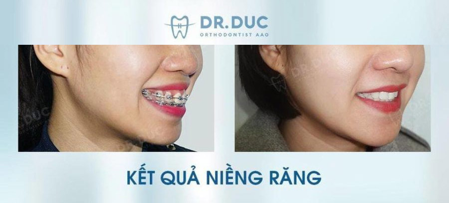 Hình ảnh trước- sau với niềng răng mắc cài kim loại 1 Hình ảnh trước- sau với niềng răng mắc cài kim loại 1